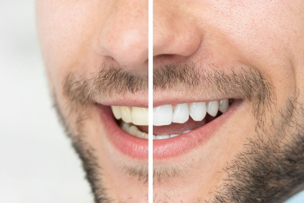 man teeth whitening tooth secrets